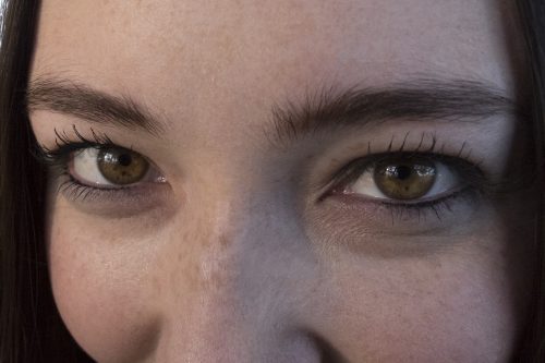 Freckles in the eyes