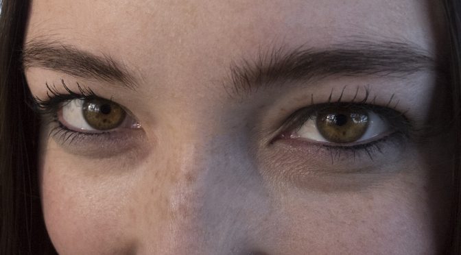 Freckles in the eyes